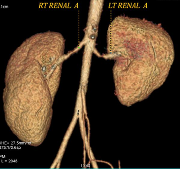 <b>Figure 3:</b> CT angiography shows string of beads appearance with marked narrowing of mid segment of bilateral renal arteries.